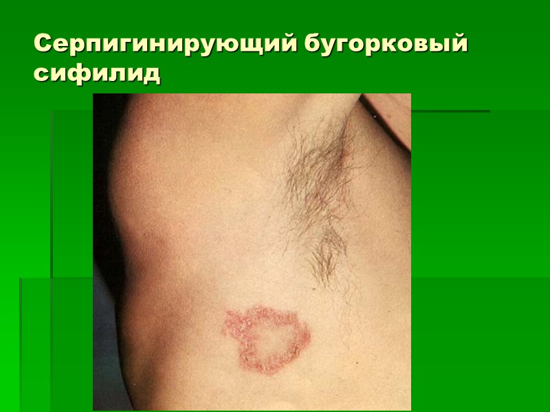 Серпигинирующий бугорковый сифилид